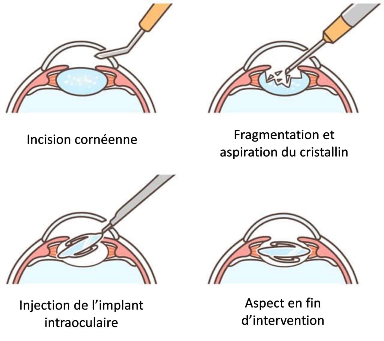 etapes-chirurgie-cataracte-2