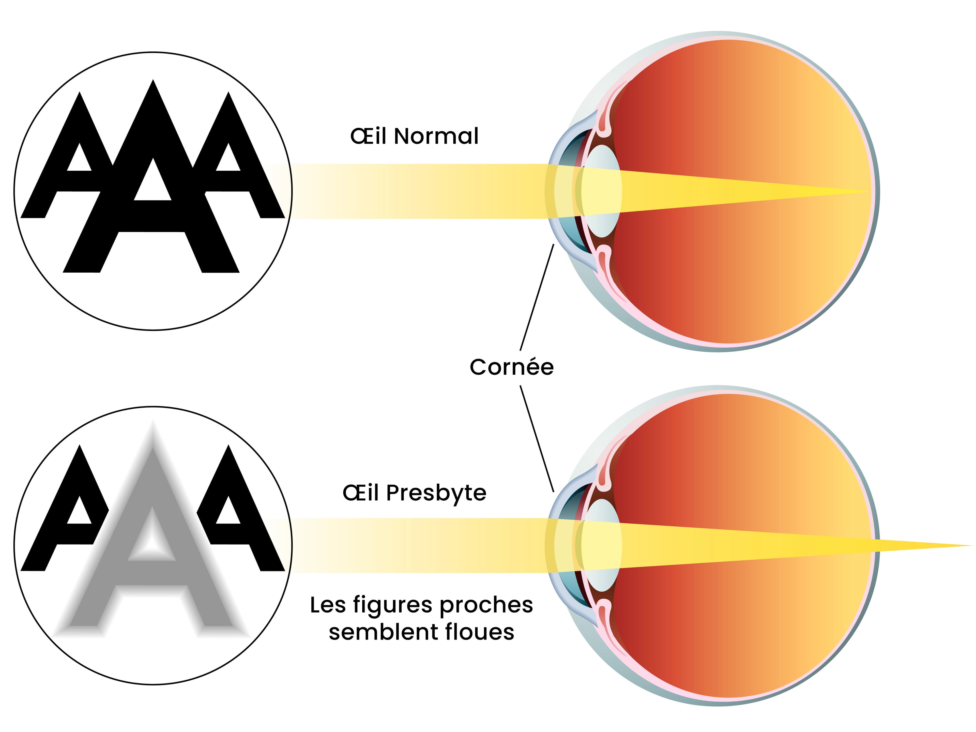 Oeil presbyte