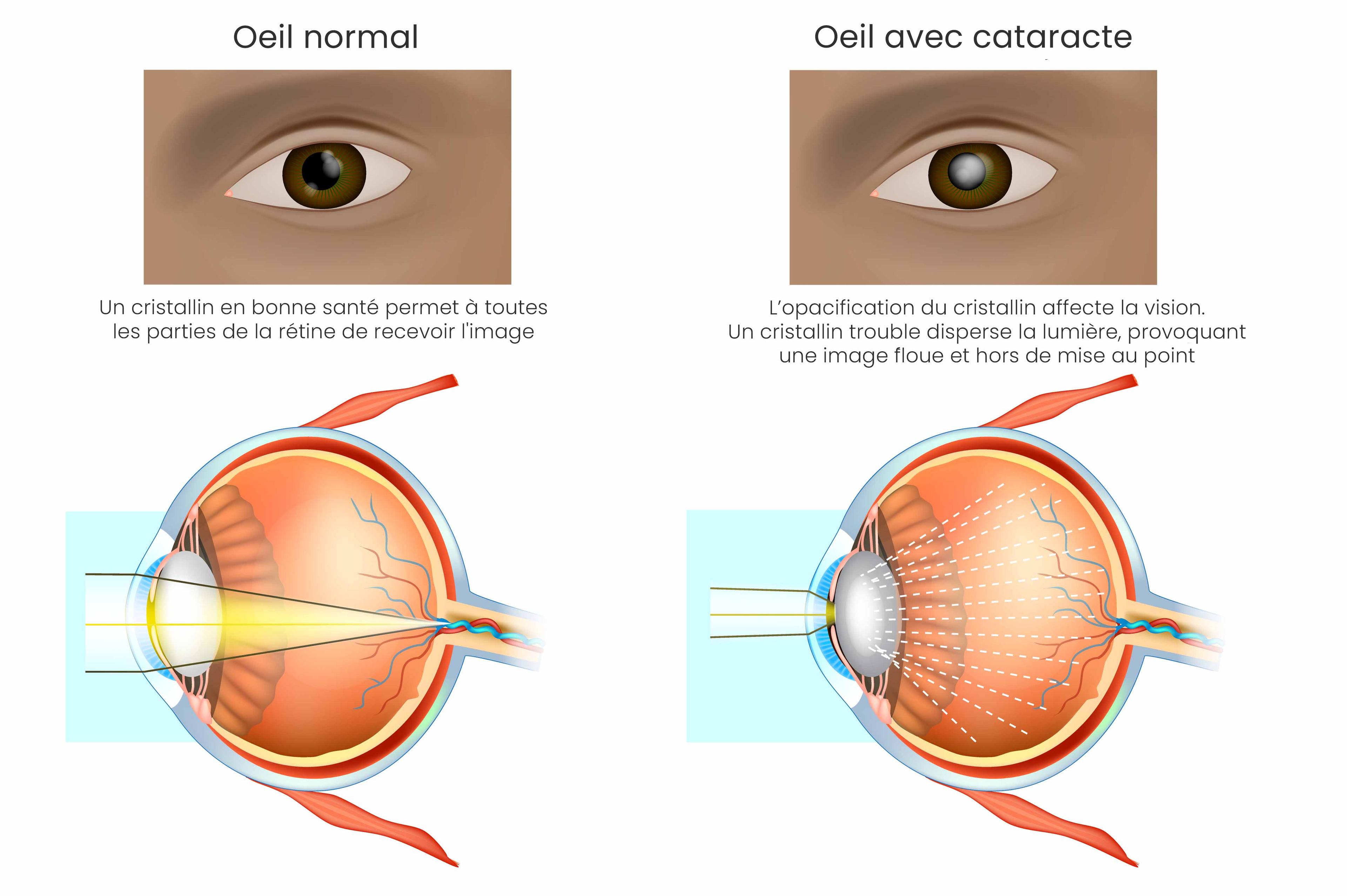 cataracte schema